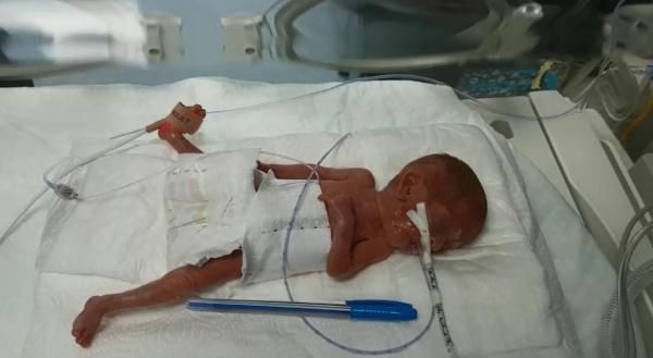 Türkiye'de bir ilk: 285 gram doğan Elçin bebek hayata tutundu