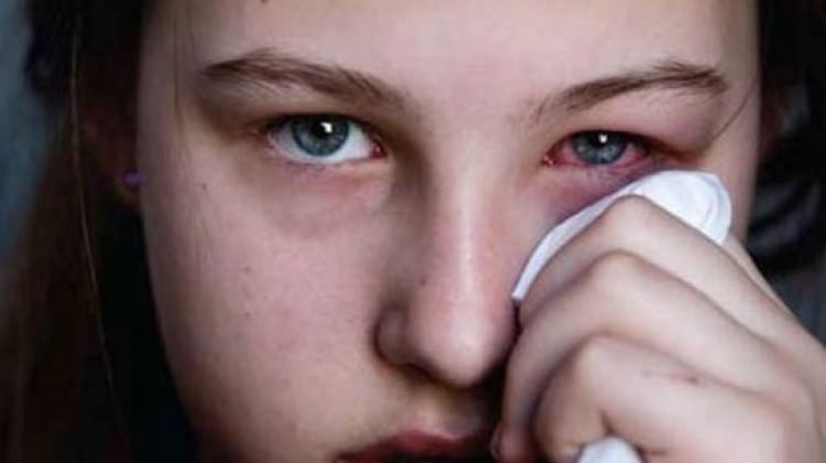 Behçet hastalığı gözleri vuruyor