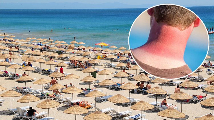 gunes-yanigi-evde-nasil-gecer-deniz-yanigini-gecirme-yollari