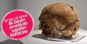 Birincil beyin ameliyatı yapılan kafatası büyük ilgi görüyor