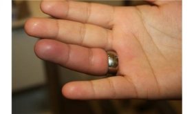 Parmağına sıkışan yüzüğü itfaiye çıkardı