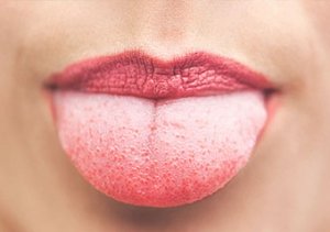 Dil kanserinin belirtileri