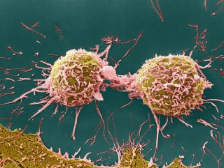 Kanserli hücrelerin çoğalmasını önleyen madde bulundu