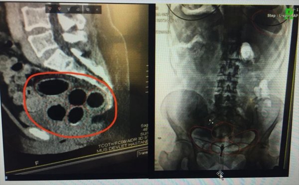 Midesinden 7 paket uyuşturucu çıktı