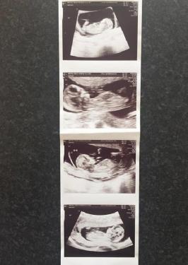 50 yaşındaki kadın, en yaşlı dördüz annesi olacak