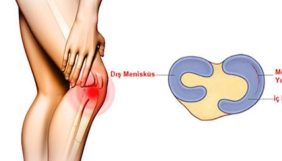 Diz menisküs yırtığı nedir? Diz menisküs yırtığı belirtileri nelerdir? Diz menisküs yırtığı tedavisi nasıl olur?