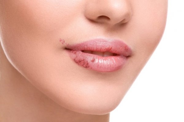 Herpes simplex nedir