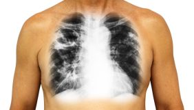 KOAH ölümcül bir hastalık mı? KOAH ölümleri engellenebilir mi? KOAH tedavisi büyük tartı taşıyor