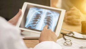 Verem nedir? Tüberküloz belirtileri ve tedavisi nasıl olur?