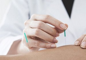 Akupunktur: Zayıflamanın en geleneksel yöntemi