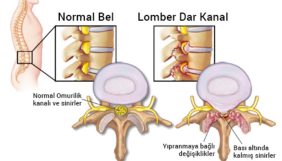 Bel bölgesinde omurilik daralmasında ameliyat seçenekleri nelerdir?