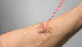 YANMA IZI tedavisi nedir? YANIK IZI nasıl geçer? YANIK IZI kalmaması için ne yapmalı?