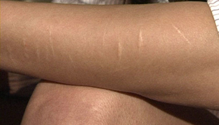 Faça ve tıraş bıçağı izlerinden nasıl kurtuluruz?