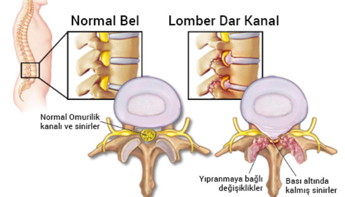 Bel bölgesinde omurilik daralmasında ameliyat seçenekleri nelerdir?