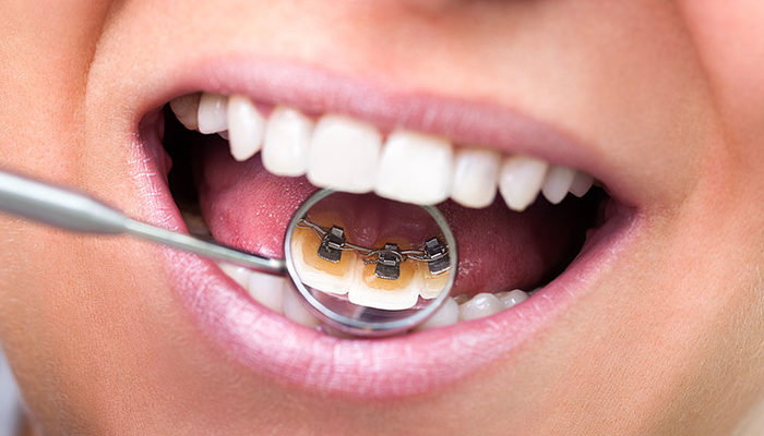 Lingual diş teli nedir?