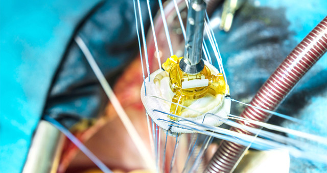 Ankara’da Kurulacak Tesisle Kalp Kapakları ve Biyoloji Ile Ilgili Greftler Artık Türkiye’de Üretilecek