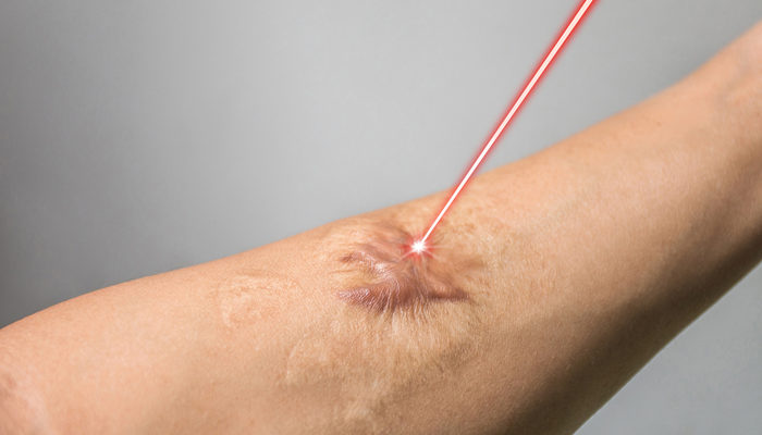 YANMA IZI tedavisi nedir? YANIK IZI nasıl geçer? YANIK IZI kalmaması için ne yapmalı?